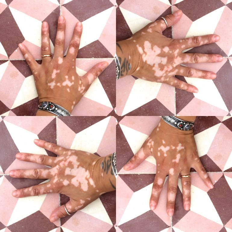vitiligo