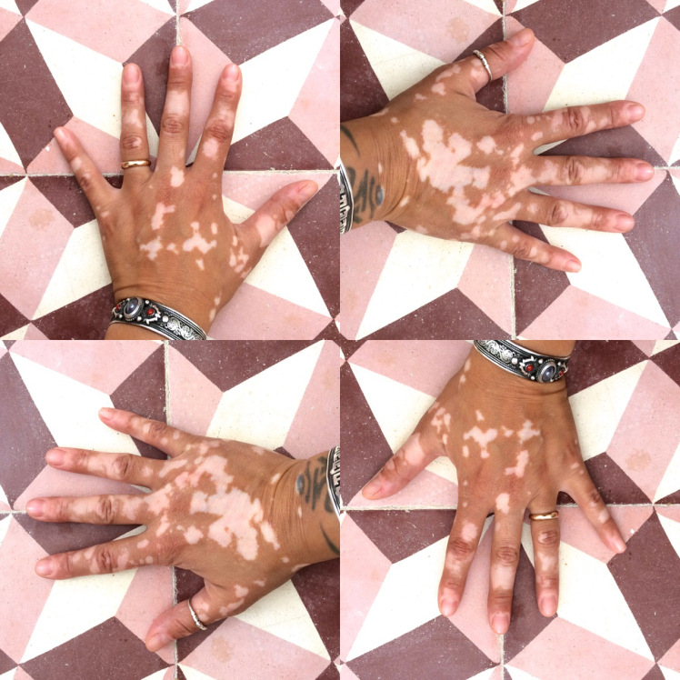 vitiligo 2017